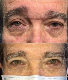 ptosis