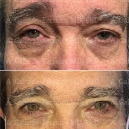 ptosis