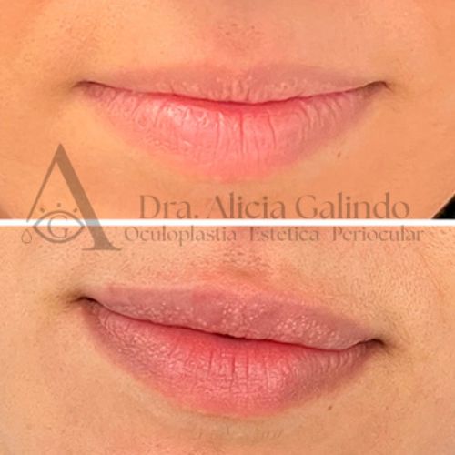 Labios rellenos