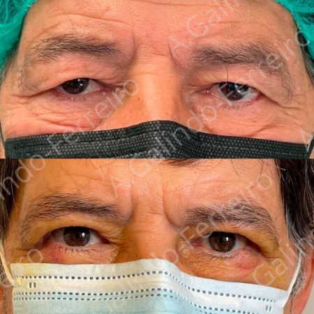 Cirugía ocular Valladolid