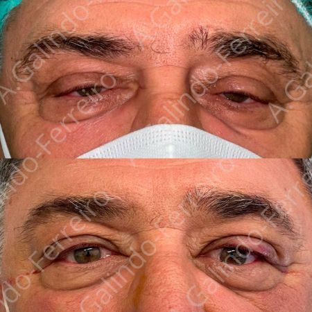 Cirugía ocular Valladolid