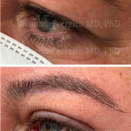 Blefaroplastia superior