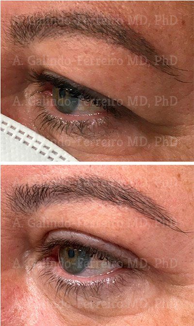 Blefaroplastia superior
