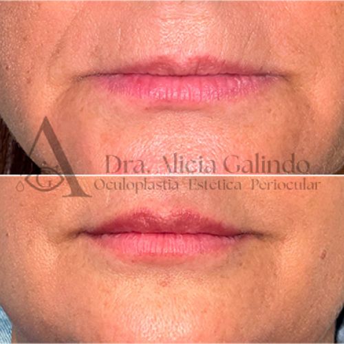 Labios medicina estética