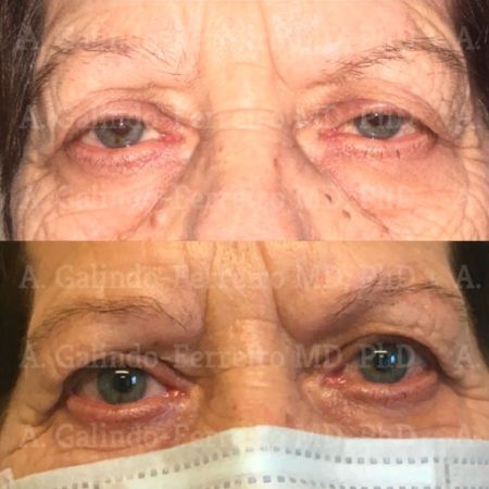 Cirugía ocular Valladolid