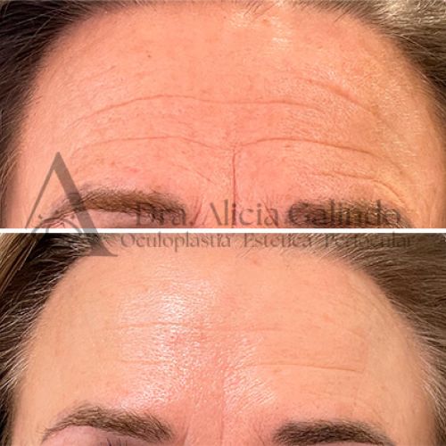 Arrugas medicina estética