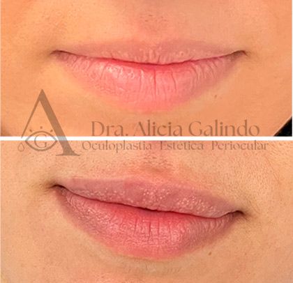 labios rellenos
